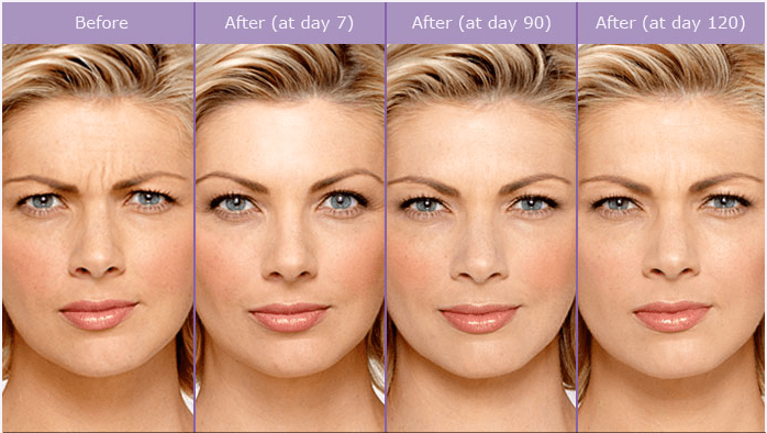 BOTOX
