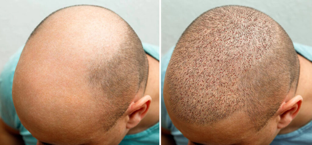FUE HAIR TRANSPLANT
