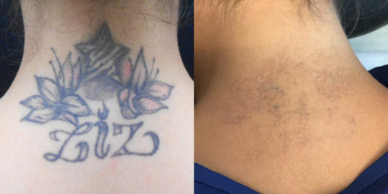 LASER TATTOO REMOVAL