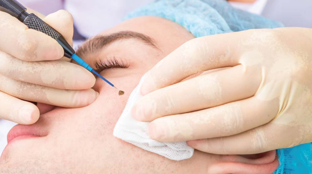 RADIOFREQUENCY / ELETROCAUTERY